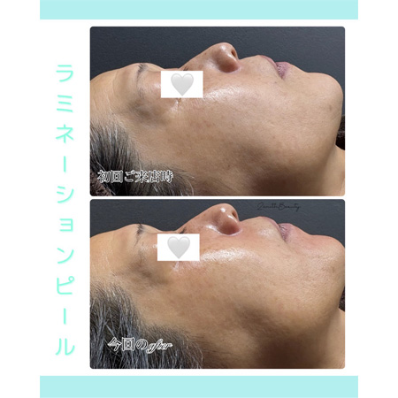 ラミネーションピール 1回で効果抜群