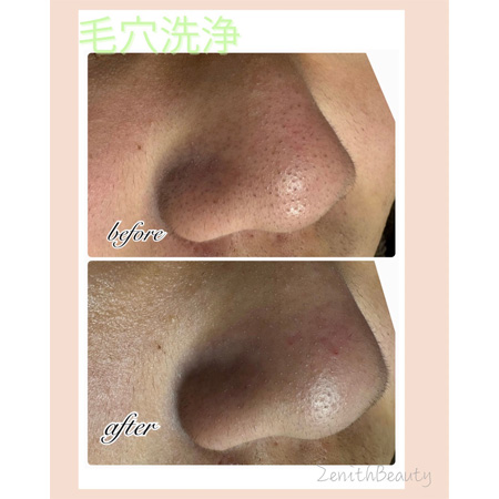 毛穴洗浄1回よりも2回3回目の効果に期待‼️